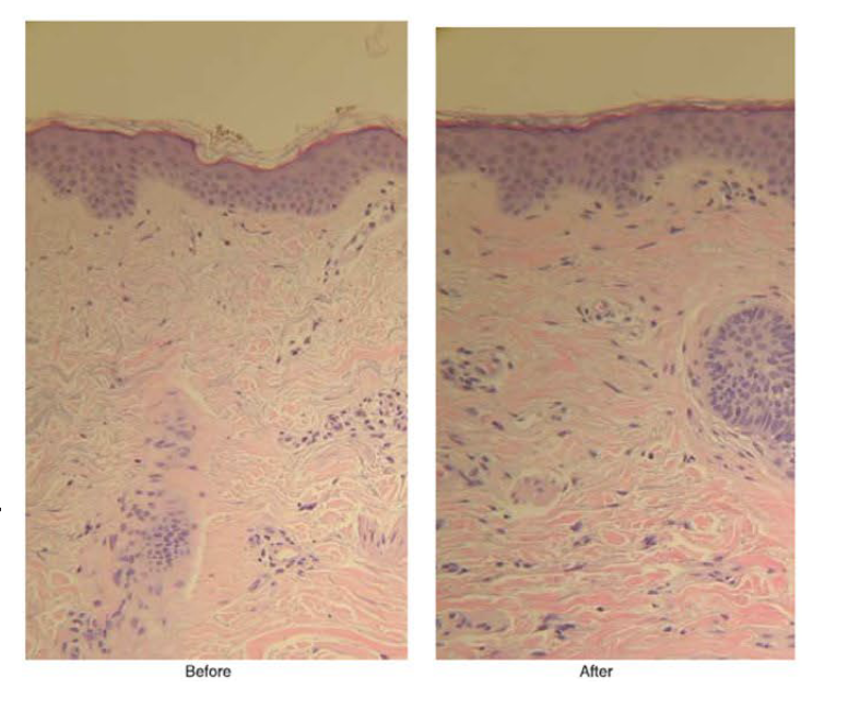 Photo histologique avant / après
