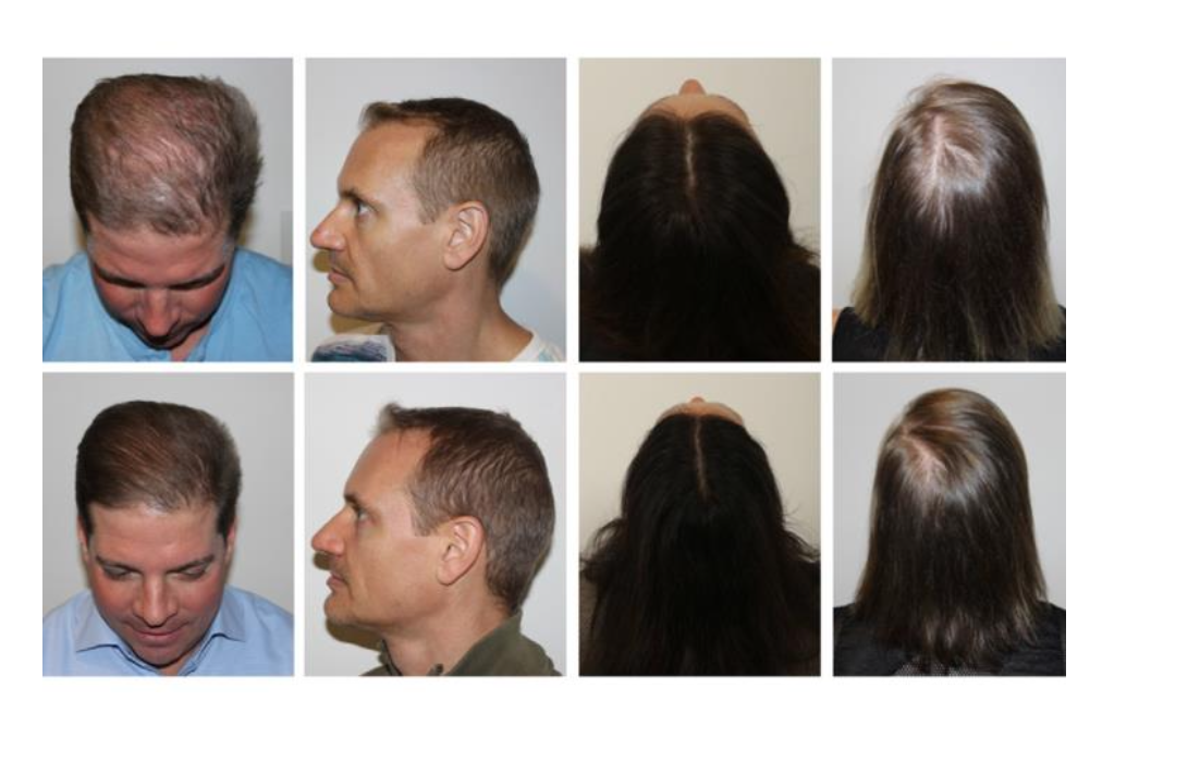 Résultats avant/après Keravive