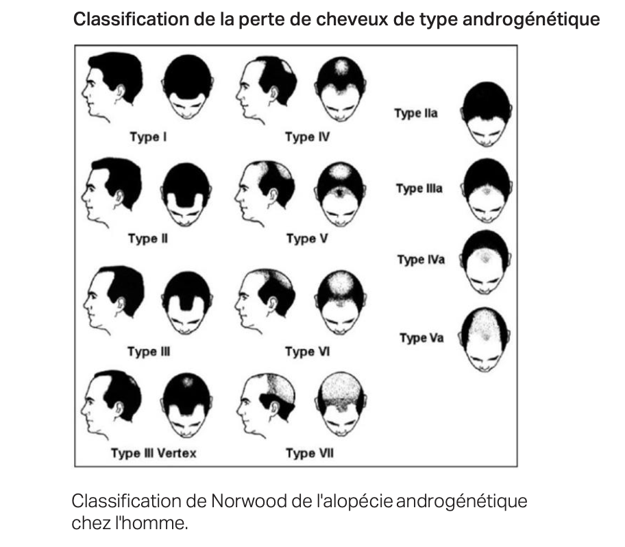 Classification de Norwood