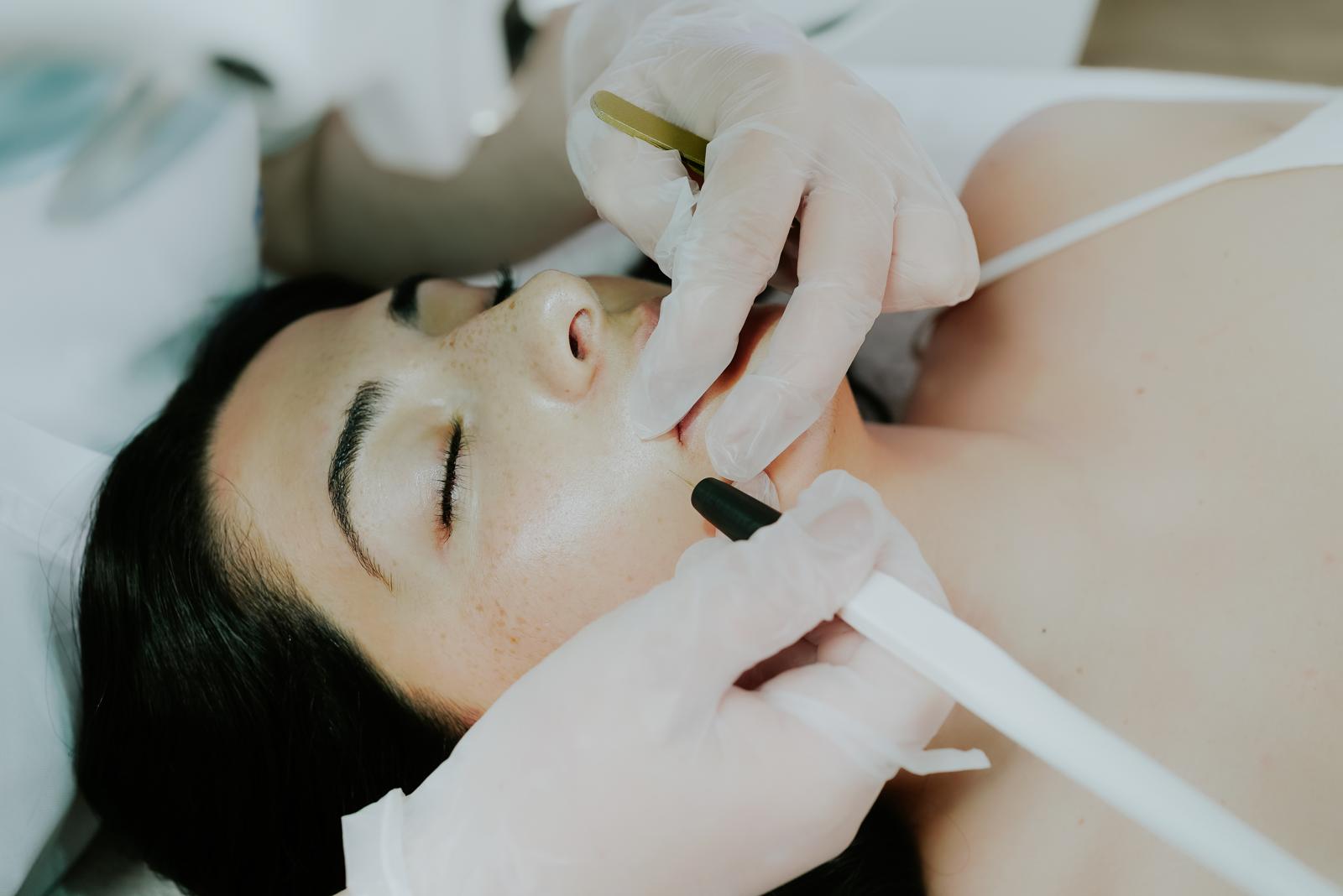 Technique épilation électrique